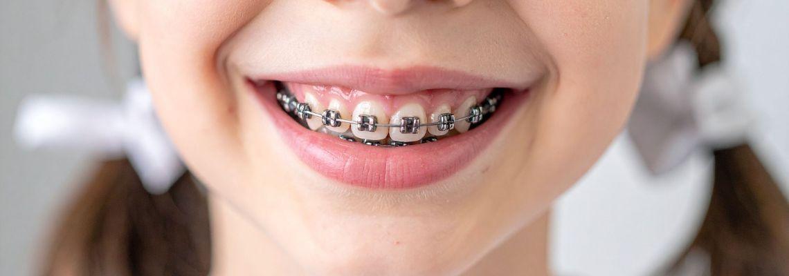 Apparecchio dentale nei bambini, quando è necessario